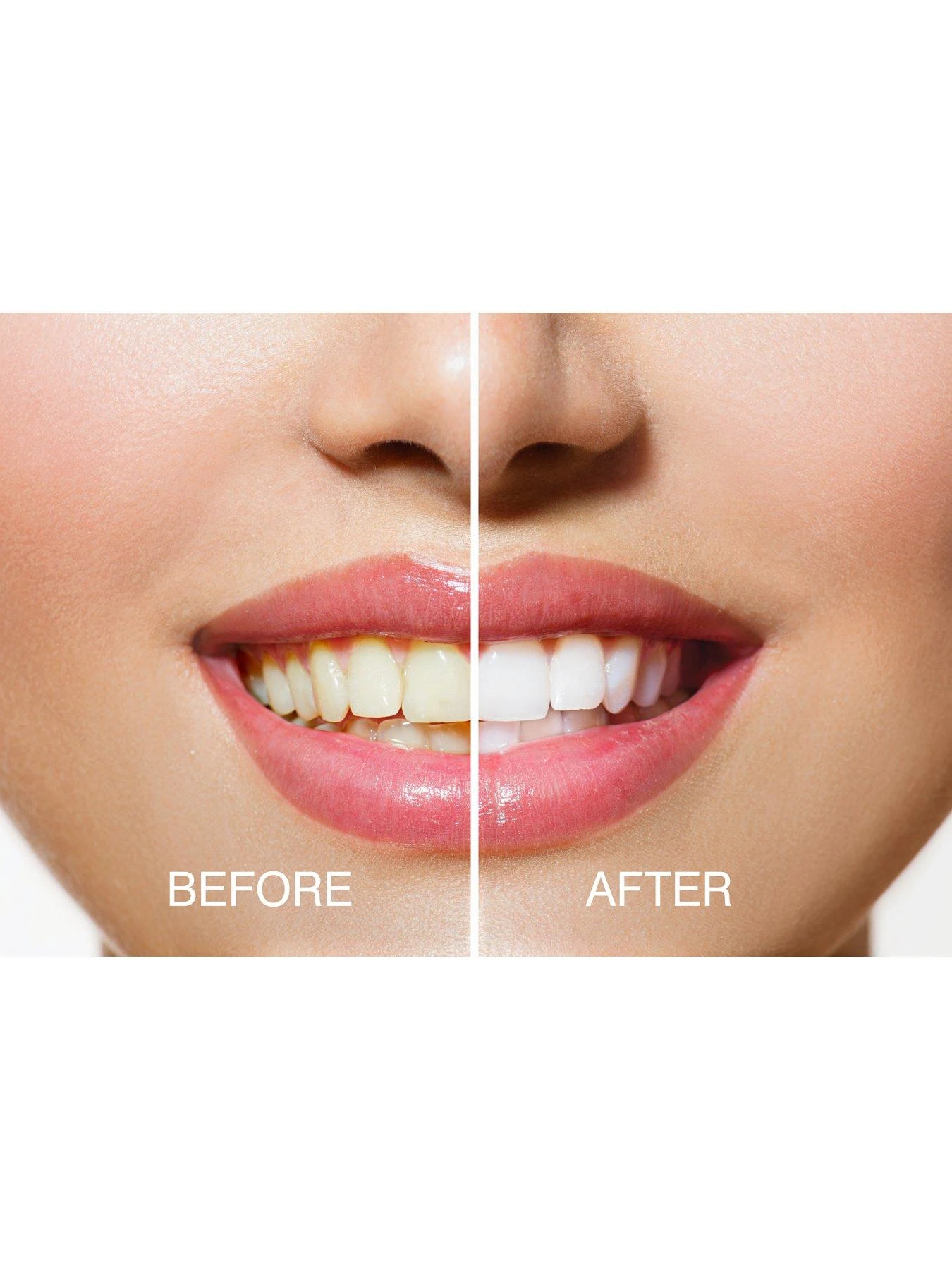 Rio Smile White Advanced Blue-Light Teeth Whitening Kit 5 Rio Smile White Advanced Blue-Light Teeth Whitening Kit - Image 3